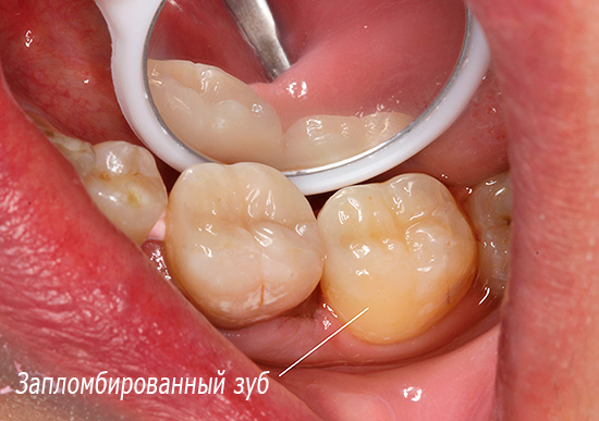 Anche dopo il trattamento della carie superficiale, a volte può verificarsi dolore nel dente sotto le otturazioni.