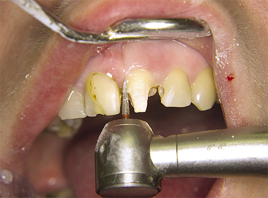 L'esposizione attiva al dente con un trapano senza un adeguato raffreddamento può provocare ustioni alla polpa.