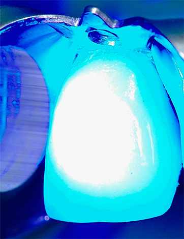 I compositi fotopolimerizzati si restringono mentre si induriscono, il che porta a stress nel dente e conseguente dolore.