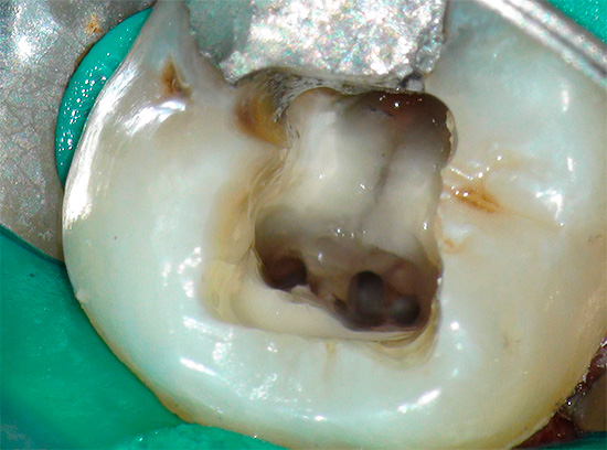 Alcuni dentisti considerano dolori ai denti minori dopo il trattamento e il riempimento dei canali completamente naturali e accettabili.