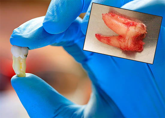 Vamos tentar descobrir como é doloroso remover um dente do siso e quanto tempo depois essa dor na gengiva geralmente persiste.