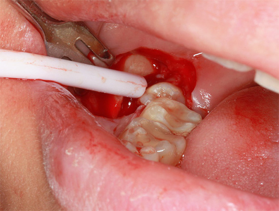 No corte, um dente do siso nu é visível.