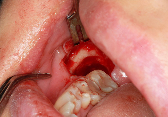 A foto mostra o buraco depois de remover o dente do siso