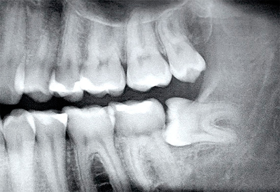 Um dente do siso de raio-x é claramente visível no raio-x (está escondido sob a gengiva)