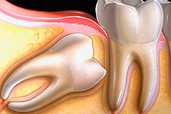Com esse arranjo, o dente do siso causará dor intensa.