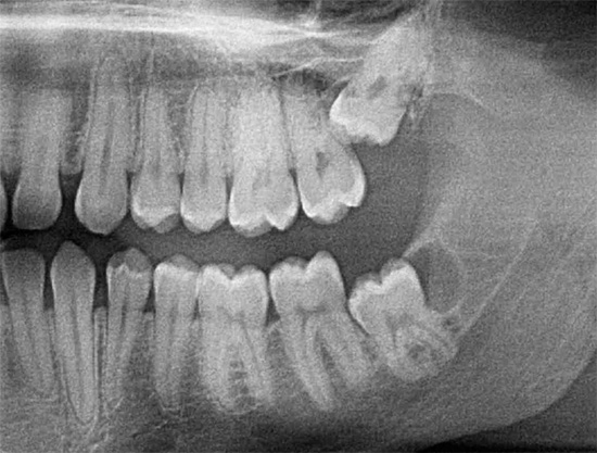 Imagem de raios-X mostra os dentes do siso superiores e inferiores