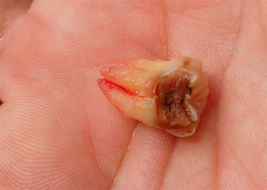 Dente do siso rasgado