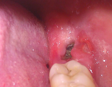 Para a rápida cicatrização das gengivas após a remoção do dente do siso, é importante seguir todas as prescrições do médico.