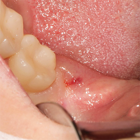A foto mostra uma gengiva inflamada com um dente do siso localizado embaixo dela.