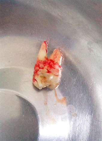 Foto de um dente do siso removido em uma escarradeira