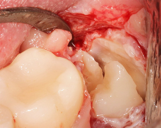 A extração dentária complexa é geralmente um procedimento muito mais doloroso e desagradável do que o simples.