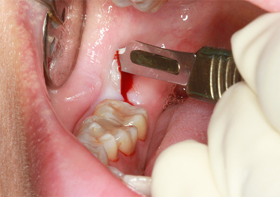 Incisão gengival