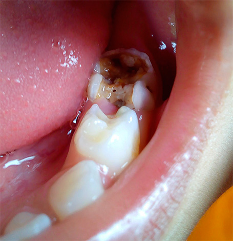 Non dovremmo dimenticare che il farmaco aiuta solo ad alleviare temporaneamente il dolore, ma non elimina la necessità di visitare il dentista.