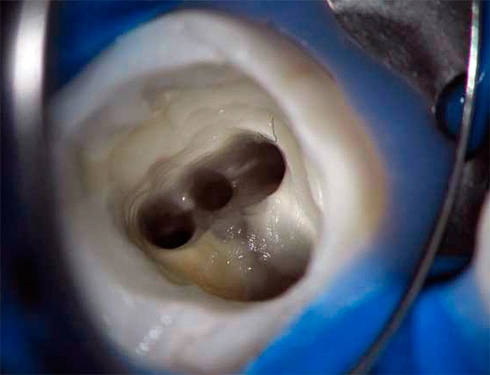 No tratamento da pulpite, é muito importante limpar os canais dentários dos resíduos e infecções da polpa.