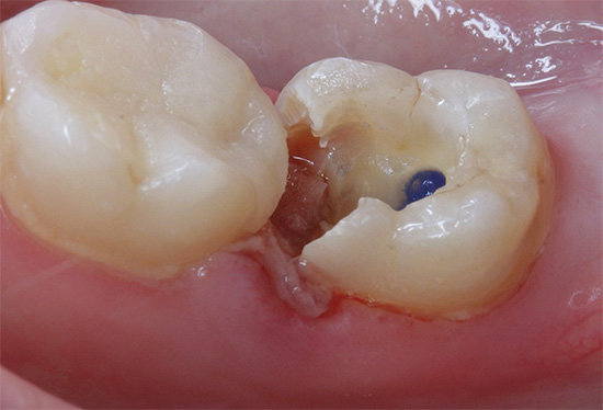 É assim que o dente fica no início do procedimento de tratamento - o material desvitalizante é visível na boca do canal radicular.