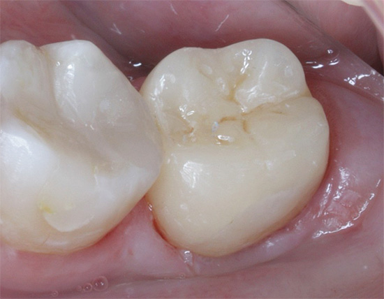E assim o mesmo dente cuida do tratamento.