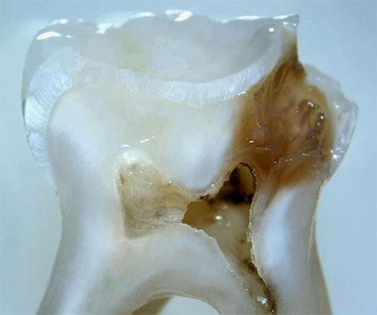 Pode ser visto na seção que a cavidade cariosa chegou perto da câmara pulpar do dente.