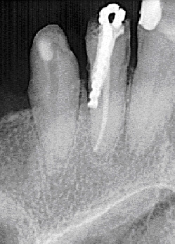 O raio-x mostra um exemplo de perfuração de uma raiz dentária.