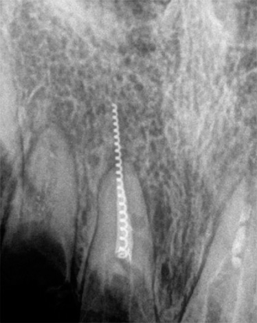 Outro tiro, no qual um instrumento quebrado é claramente visível, preso no canal dentário com saída além das bordas da raiz do dente.