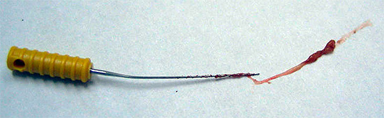 Na maioria dos casos, o tratamento da pulpite envolve a remoção completa da polpa do dente.