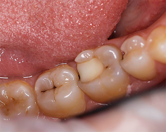 Se hai intenzione di alleviare il mal di denti con i rimedi popolari, sarà utile prima capire chi di loro funziona davvero, e quali non danno un risultato e sono persino pericolosi per la salute.