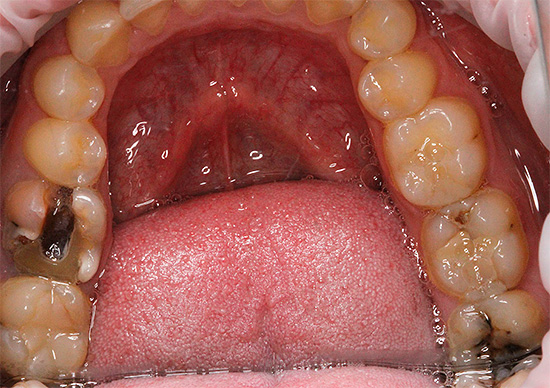 La foto mostra un dente con una profonda cavità cariata: in questi casi, il risciacquo può talvolta alleviare il dolore.