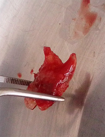 Se allevi costantemente il dolore e non tratti un dente, la sua perdita non è la cosa peggiore che può aspettarti in caso di gravi complicazioni.
