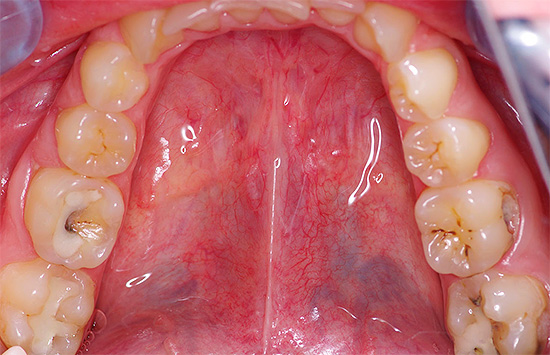 Se i tuoi denti fanno molto male, allora c'è sempre una ragione per questo - è la sua eliminazione che dovresti pensare prima.