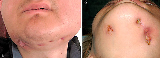 E questa foto mostra un esempio degli effetti dell'osteomielite odontogena.