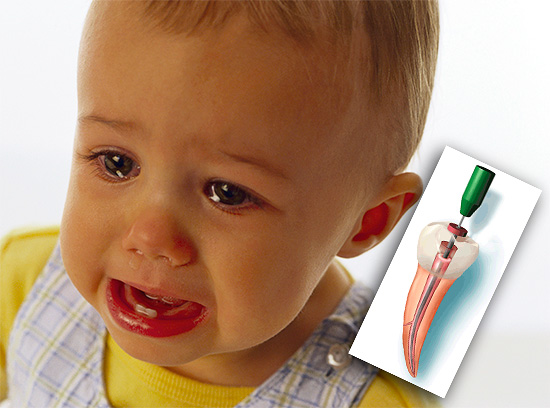 Considere as principais abordagens para o tratamento da pulpite de dentes decíduos em odontopediatria ...