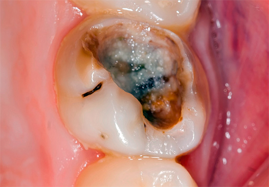 Com o método biológico de tratamento da pulpite, a cavidade cariosa é primeiro limpa de tecidos necróticos e, em seguida, é aplicada uma pasta terapêutica.