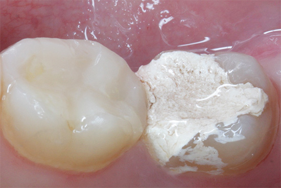 É assim que se parece um preenchimento temporário de um dente usado para matar polpa.