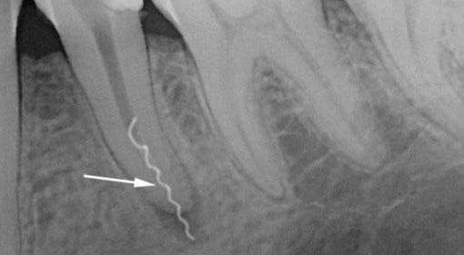 O raio-x mostra um exemplo de uma ferramenta quebrada no canal radicular do dente.