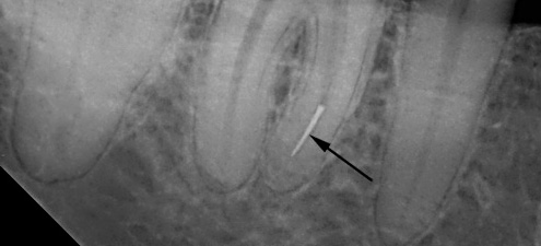 Pedaços quebrados do instrumento no canal dentário podem subsequentemente levar ao desenvolvimento de complicações ...