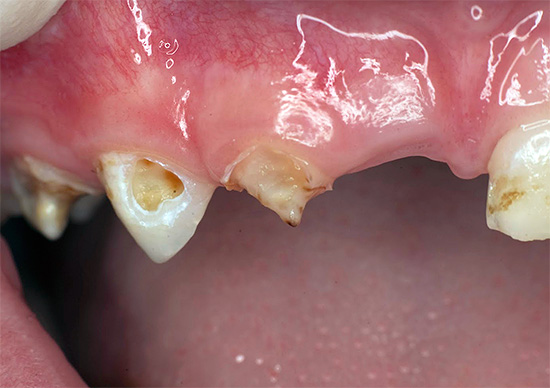 Na maioria dos casos, a pulpite de um dente de leite se desenvolve como resultado de cárie não curada a tempo.