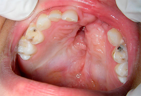 A foto mostra uma profunda cárie no dente de leite - através dele, as bactérias podem facilmente chegar à câmara pulpar.