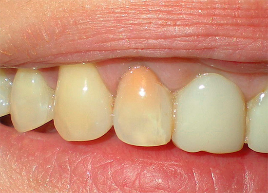 Após o tratamento da pulpite pelo método resorcinol-formalina, o dente adquire uma cor rosa ou até avermelhada.