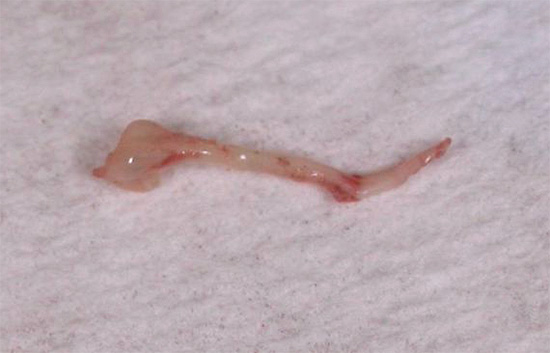 Nervo dentário remoto