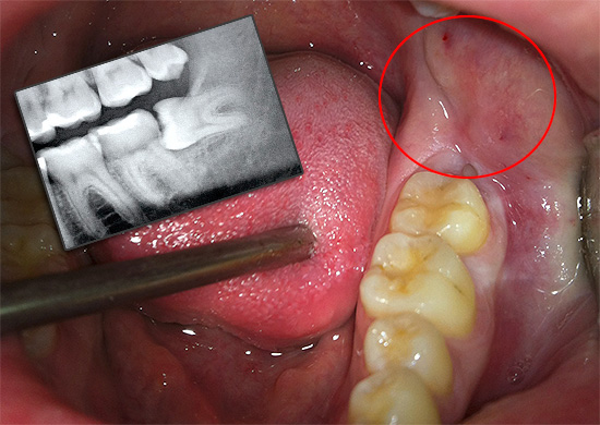Proviamo a capire cosa fare con il dolore alle gengive di un dente del giudizio in crescita e cosa può causare inazione in tali situazioni ...