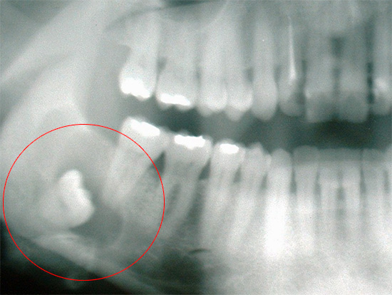 Non fare affidamento sul fatto che il dente del giudizio esplode e il dolore scompare, è meglio vedere immediatamente un dentista.