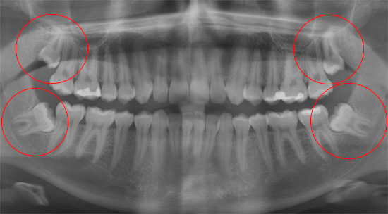 Quattro denti del giudizio sono chiaramente visibili nell'immagine panoramica.