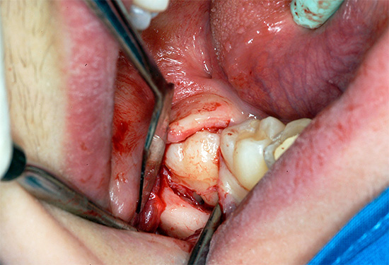 Per aiutare a esplodere il dente del giudizio, il metodo di escissione del cappuccio gengivale era spesso usato in precedenza.