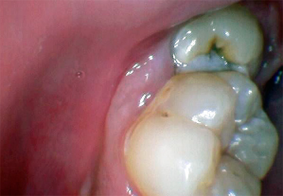 La foto mostra un dente del giudizio con carie di fessure ben visibili