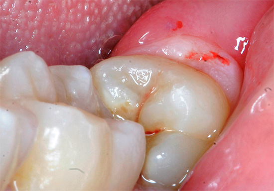 A causa delle cattive condizioni di autopulizia, i denti del giudizio sono spesso inclini a un rapido decadimento.