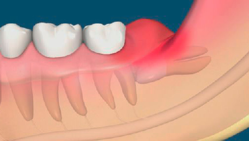 L'immagine mostra come il cappuccio di gomma copre il dente del giudizio