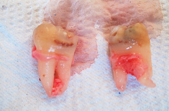 Denti del giudizio rimossi