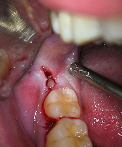 La corona del dente del giudizio è visibile nell'incisione della gomma