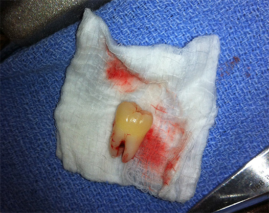 Se rimuovi il dente che irrita la gomma in tempo dall'intervento, questo eviterà molti problemi in futuro.