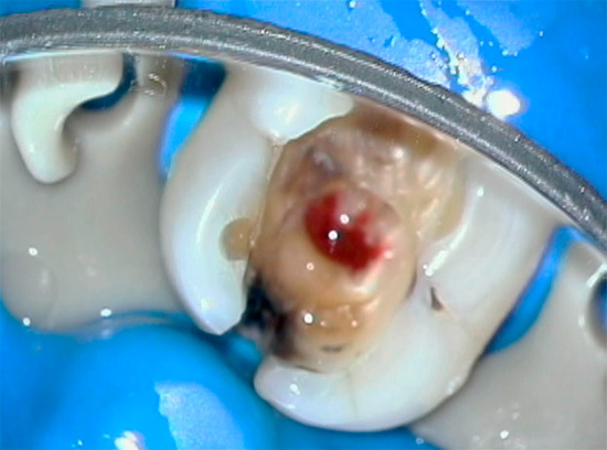 Vamos falar sobre as características da pulpite fibrosa crônica e abordagens modernas para seu diagnóstico e tratamento ...