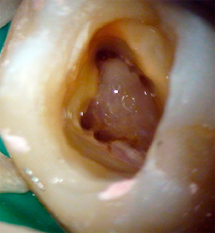 A remoção completa da polpa inflamada dos canais radiculares permite salvar o dente da fonte de infecção.